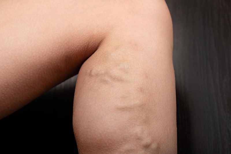<a href="https://www.shreedhruti.com/varicose-veins-2/" class="txt">Varicose-veins</a>