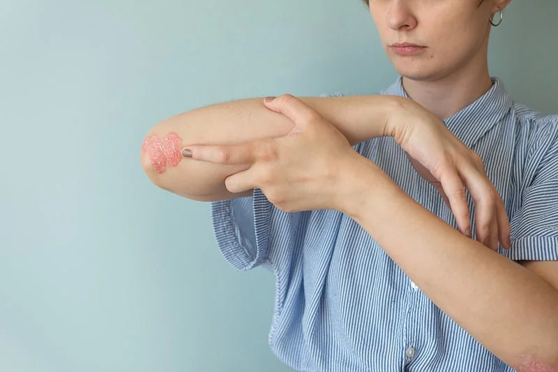 Psoriasis Disease