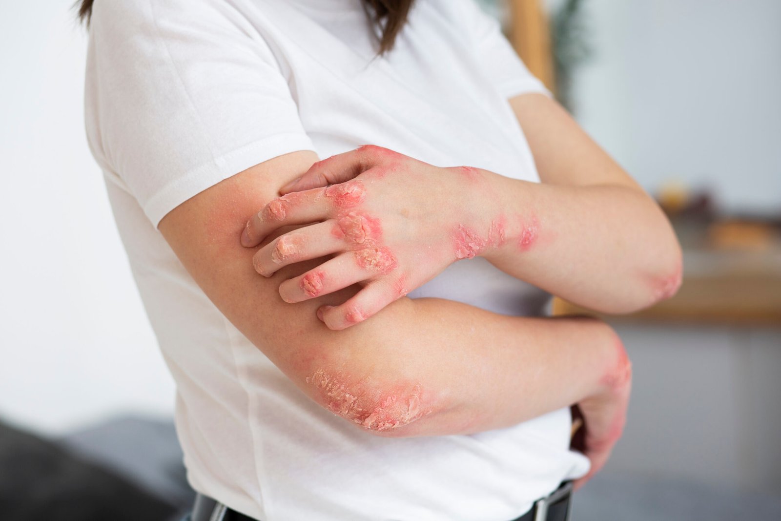 hands-patient-suffering-from-psoriasis (2)