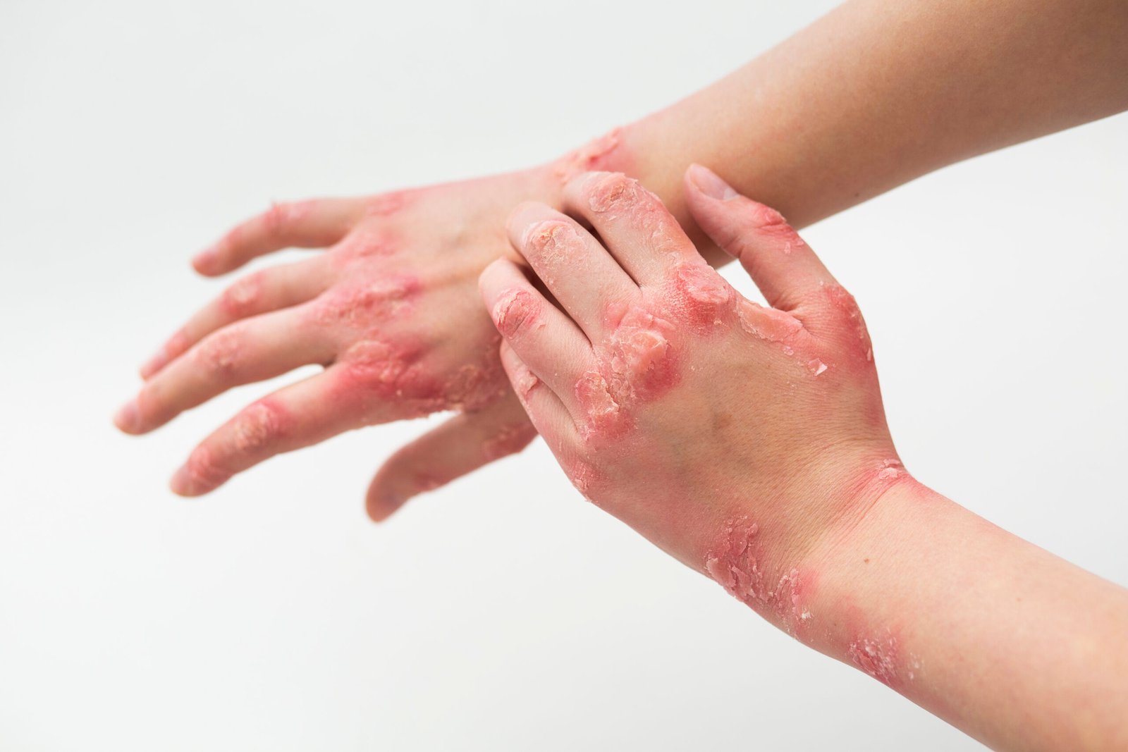 hands-patient-suffering-from-psoriasis