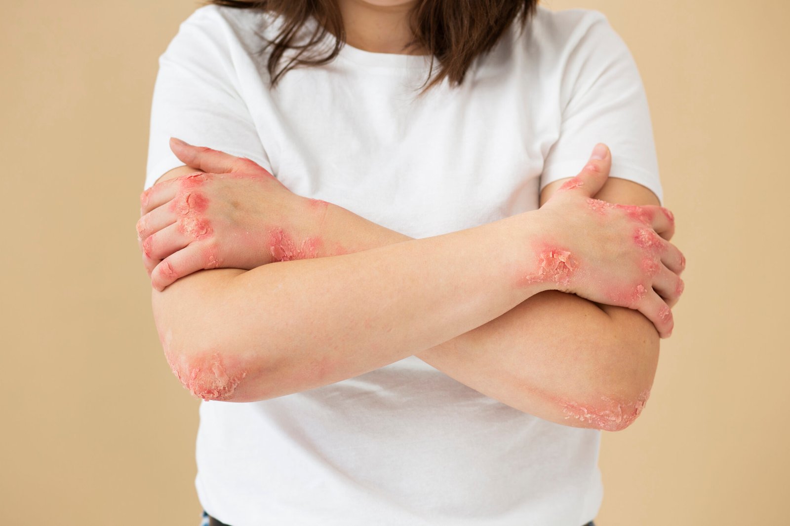 hands-patient-suffering-from-psoriasis (3)