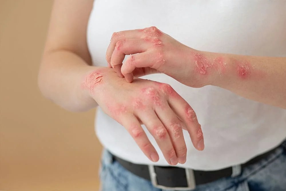 psoriasis-2